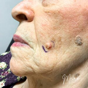 Squamous Cell Carcinoma