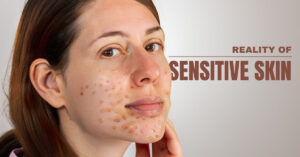 Sensitive skin.